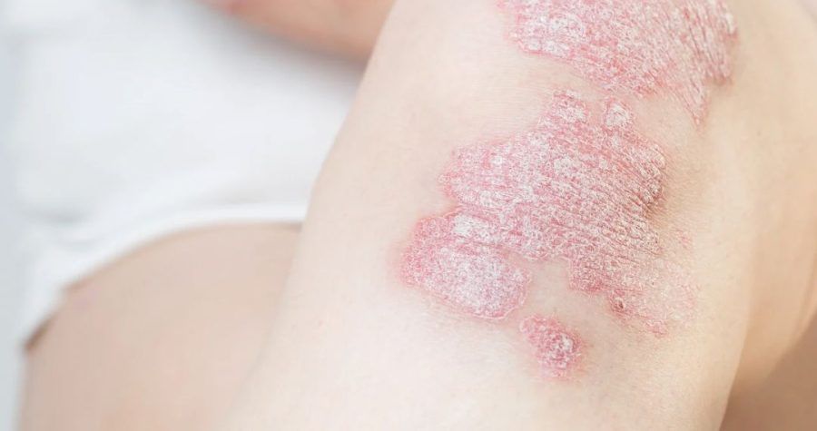 artrite psoriasica